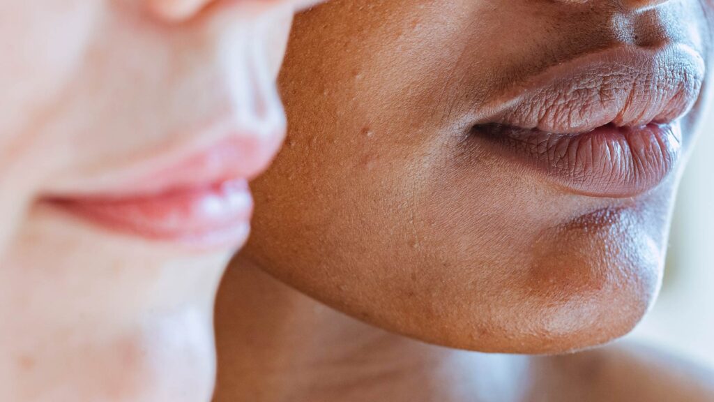Cáncer de piel no melanoma