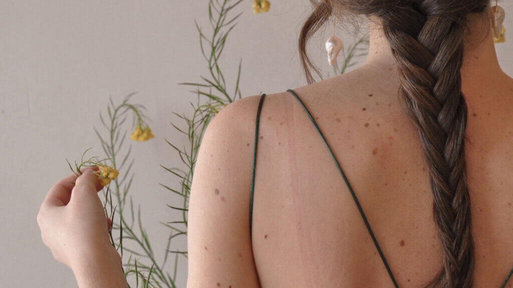 nevus. lunares. espalda