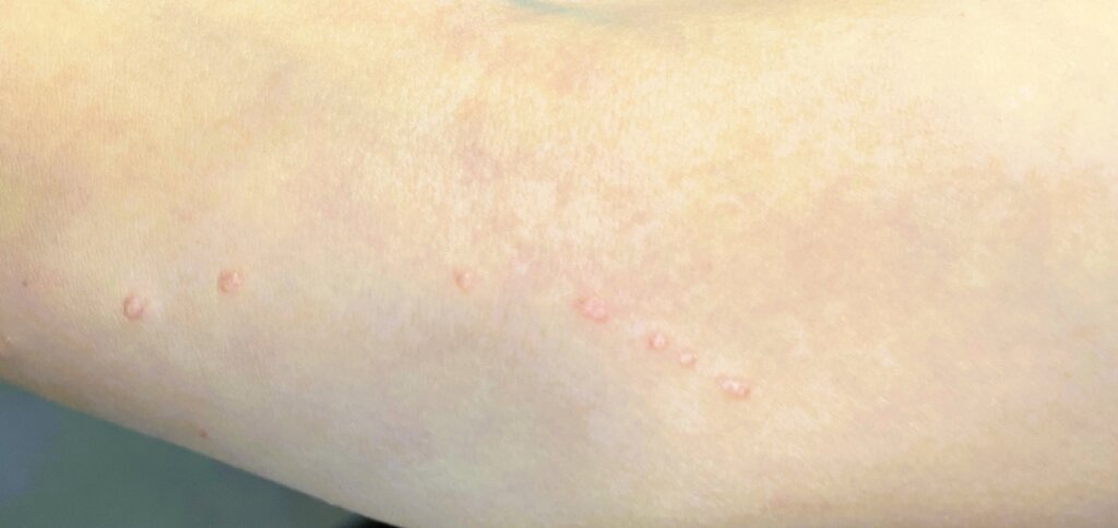 molluscum contagiosum. molusco contagioso. virus piel. fenómeno de Koebner
