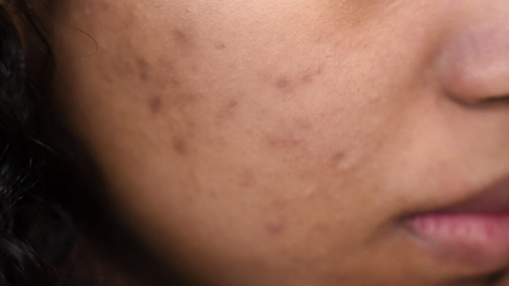 acné facial. acné con marcas