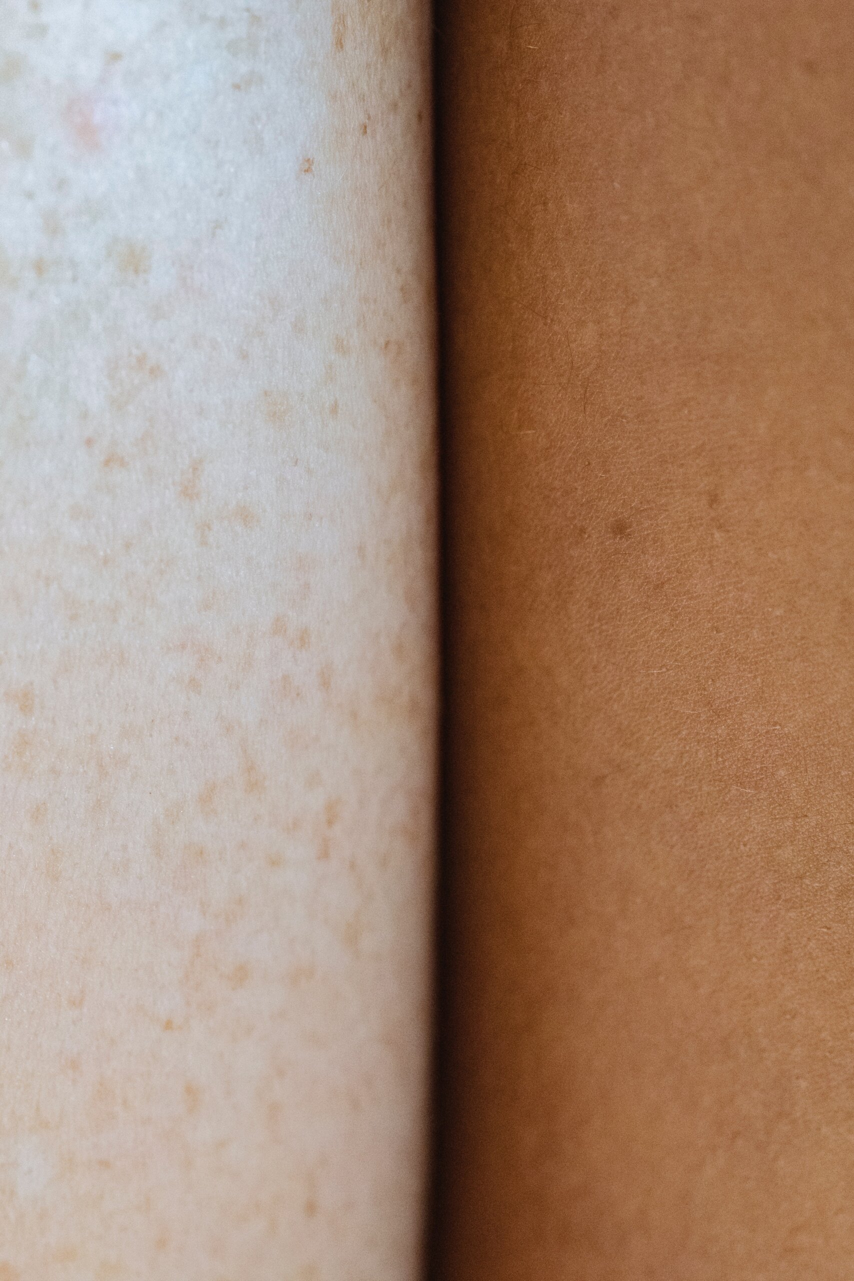 diferencias de piel y riesgo de cáncer de piel