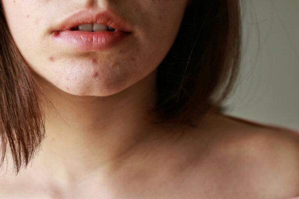 Lips,Of,A,Girl.,Acne,On,The,Chin.,Acne,Problem acné