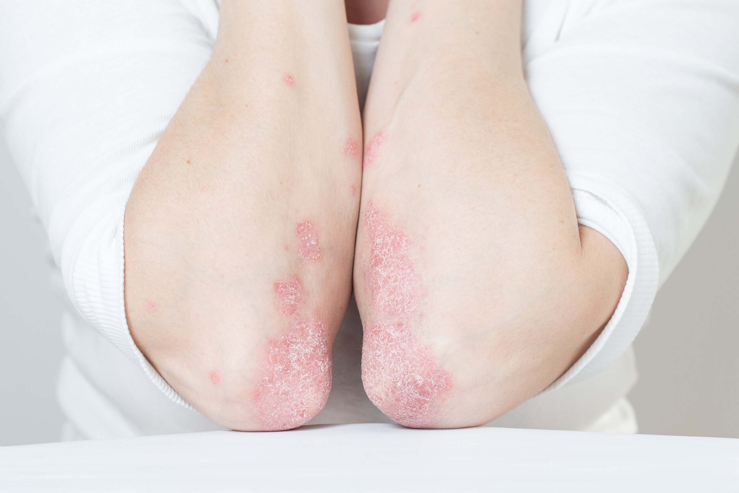 psoriasis_codos
