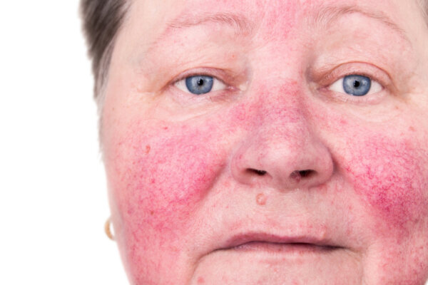 An,Elderly,Woman,With,Skin,Rosacea,Condition,Characterized,By,Facial rosácea