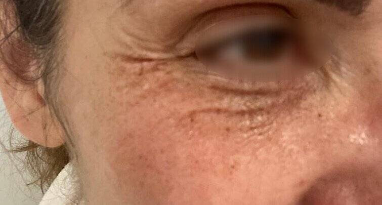 Efecto inmediato después de un láser de CO2 en arrugas de los ojos.